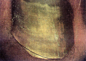 onicomicosi-2