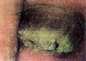 onicomicosi-4