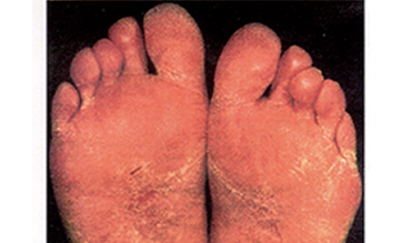 piede-diabetico-1